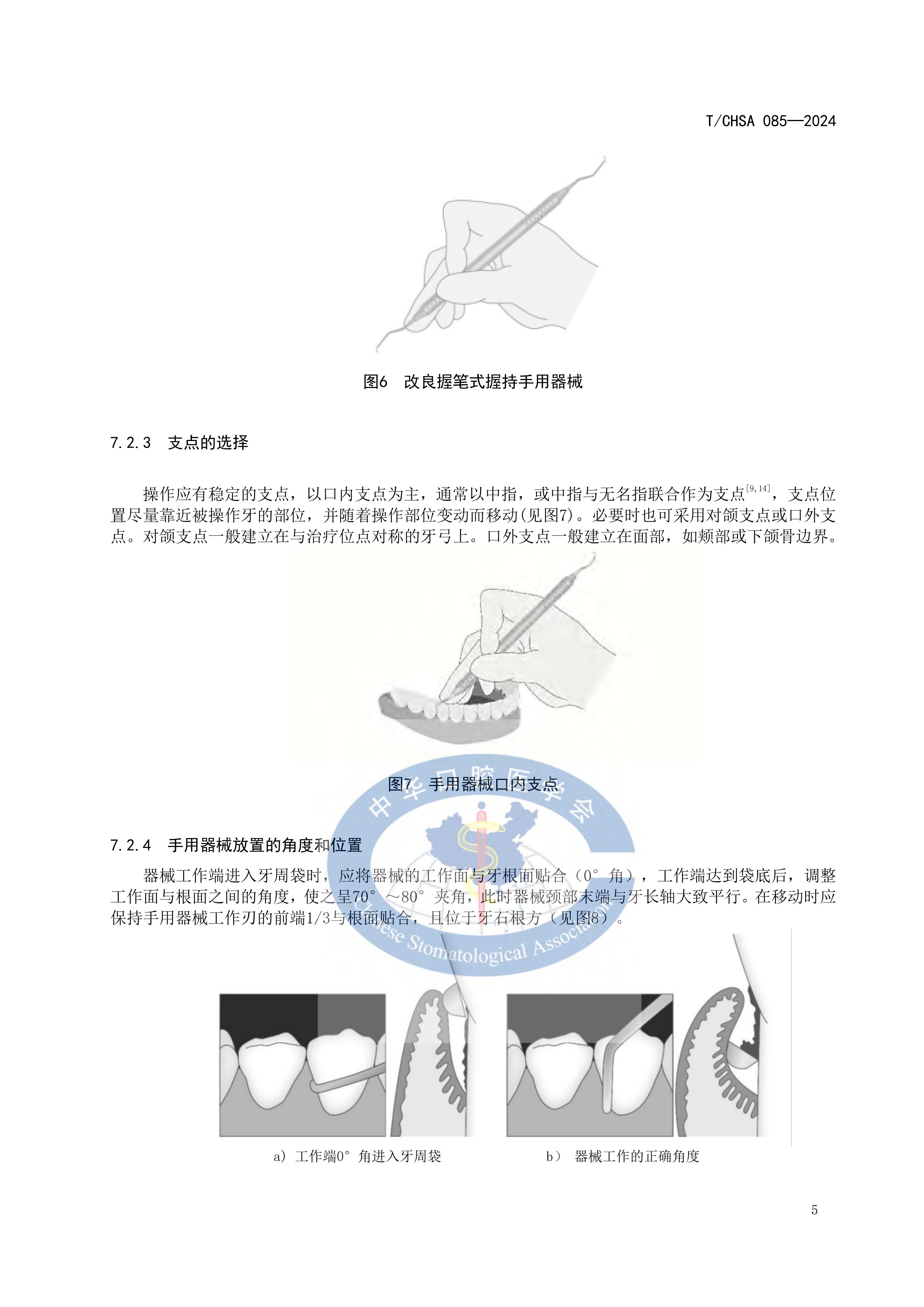 85-牙周龈下刮治和根面平整术操作规范_08.jpg